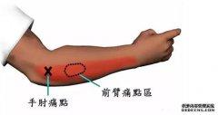 玩黑坑飞鱼出现“钓鱼肘”的预防和处理方法